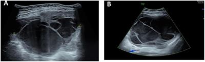 Case report: A rare case of omental extrarenal rhabdoid tumor and review of the literature